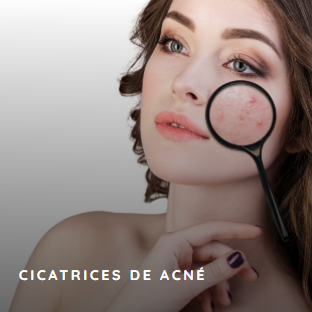 lavieen_cicatrices_de_acne_medsystems – copia